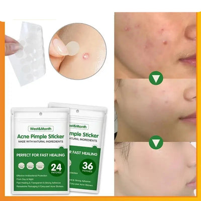 Waterproof Acne Remover Patch